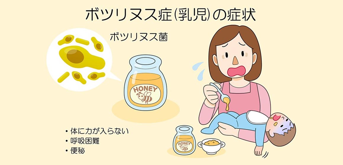 ボツリヌス症（乳児）の症状：体に力が入らない。呼吸困難。便秘。