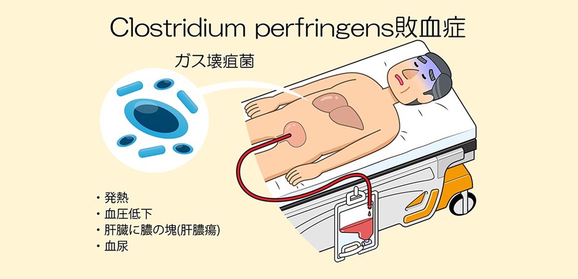 Clostridum perfringens敗血症：発熱。血圧低下。肝臓に膿の塊（肝膿瘍）。血尿。