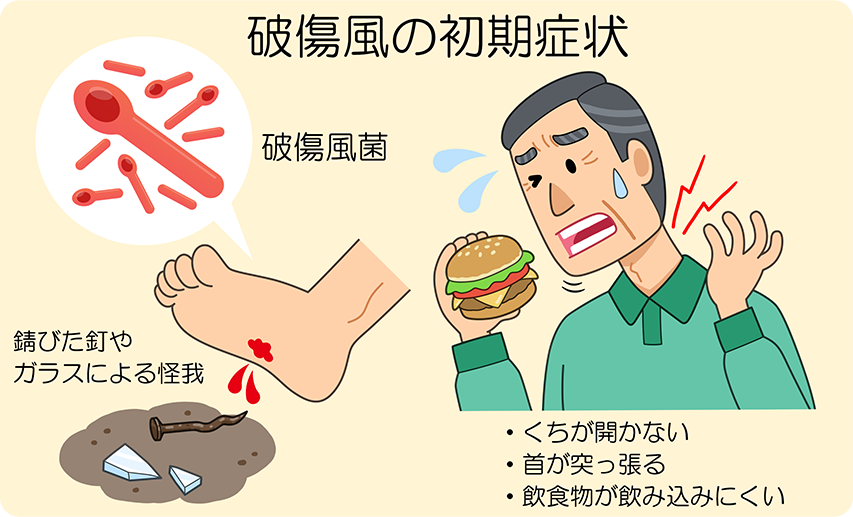 破傷風とその症状