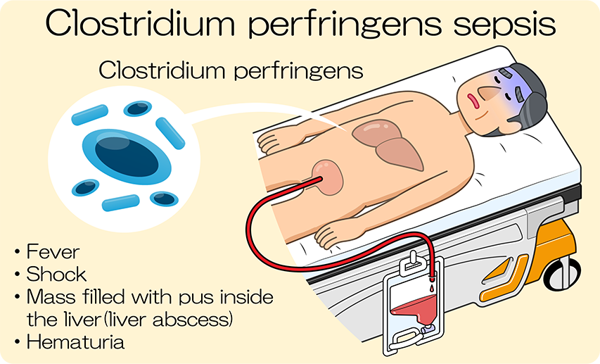 Clostridum perfringens sepsis: fever. Decreased blood pressure. Pus in the liver (liver abscess). Hematuria.