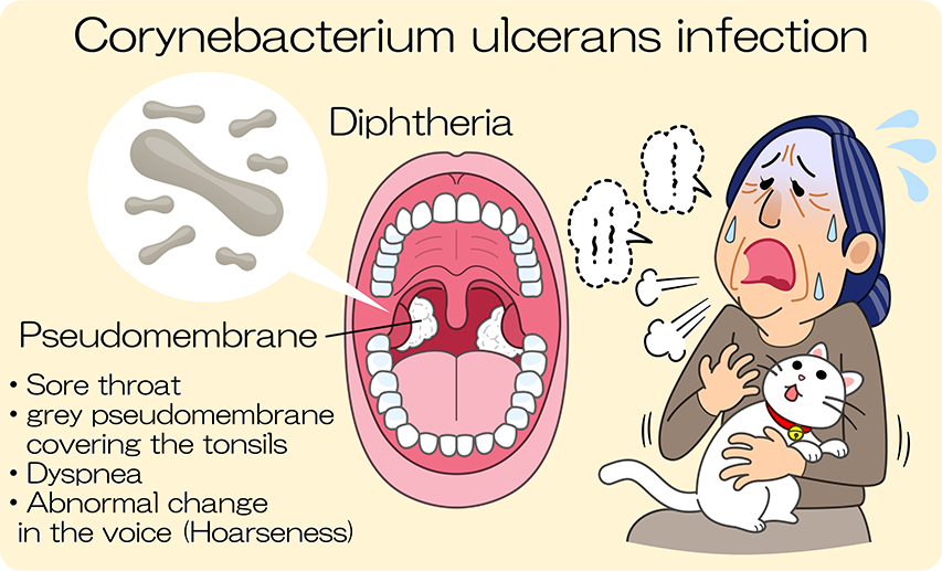 Corynebacterium ulcerans infection: sore throat. White pseudomembrane in the pharynx and other parts of the throat. Dyspnea. Hoarseness of voice.