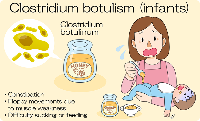 Symptoms of botulism (infant): weakness. Dyspnea. Constipation.