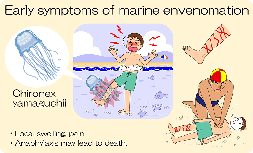 Initial symptoms of Marine Envenomation：Local swelling and pain. Anaphylactic shock, which can lead to death.