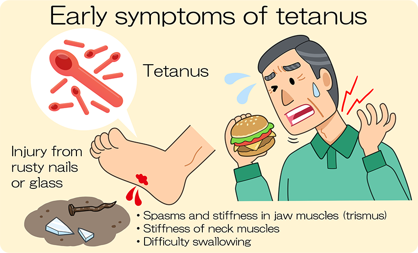 Early symptoms of tetanus: unable to open mouth. Stiff neck. Difficulty swallowing food and drink.